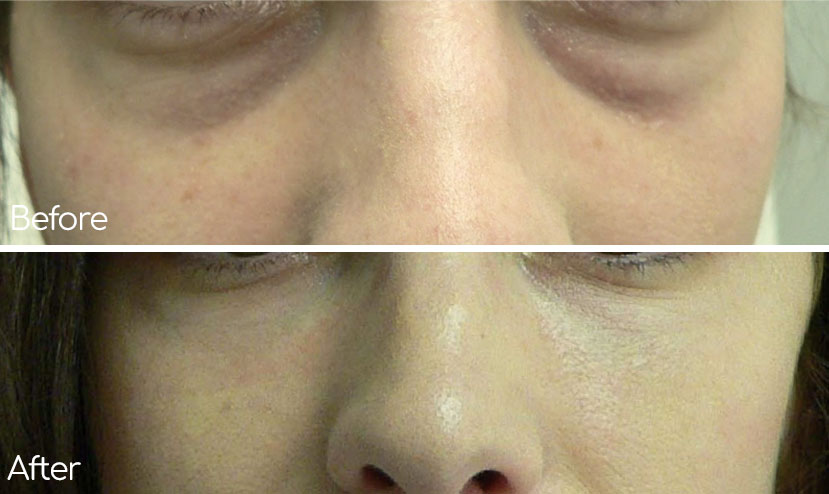 Waistline and Stomach smartlipo new york